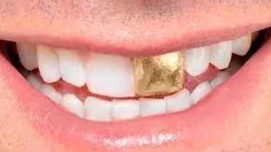 Diş Tedavisinde Altın Kullanmak Caiz Midir?